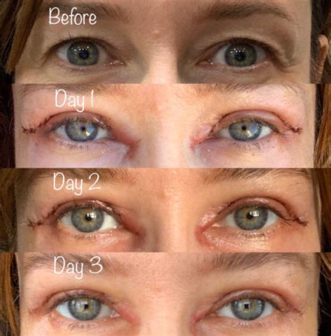 Test the ice pack/warm pack on your hand before putting it on your face and make sure to cover your eyes before . . Upper blepharoplasty recovery photos day by day